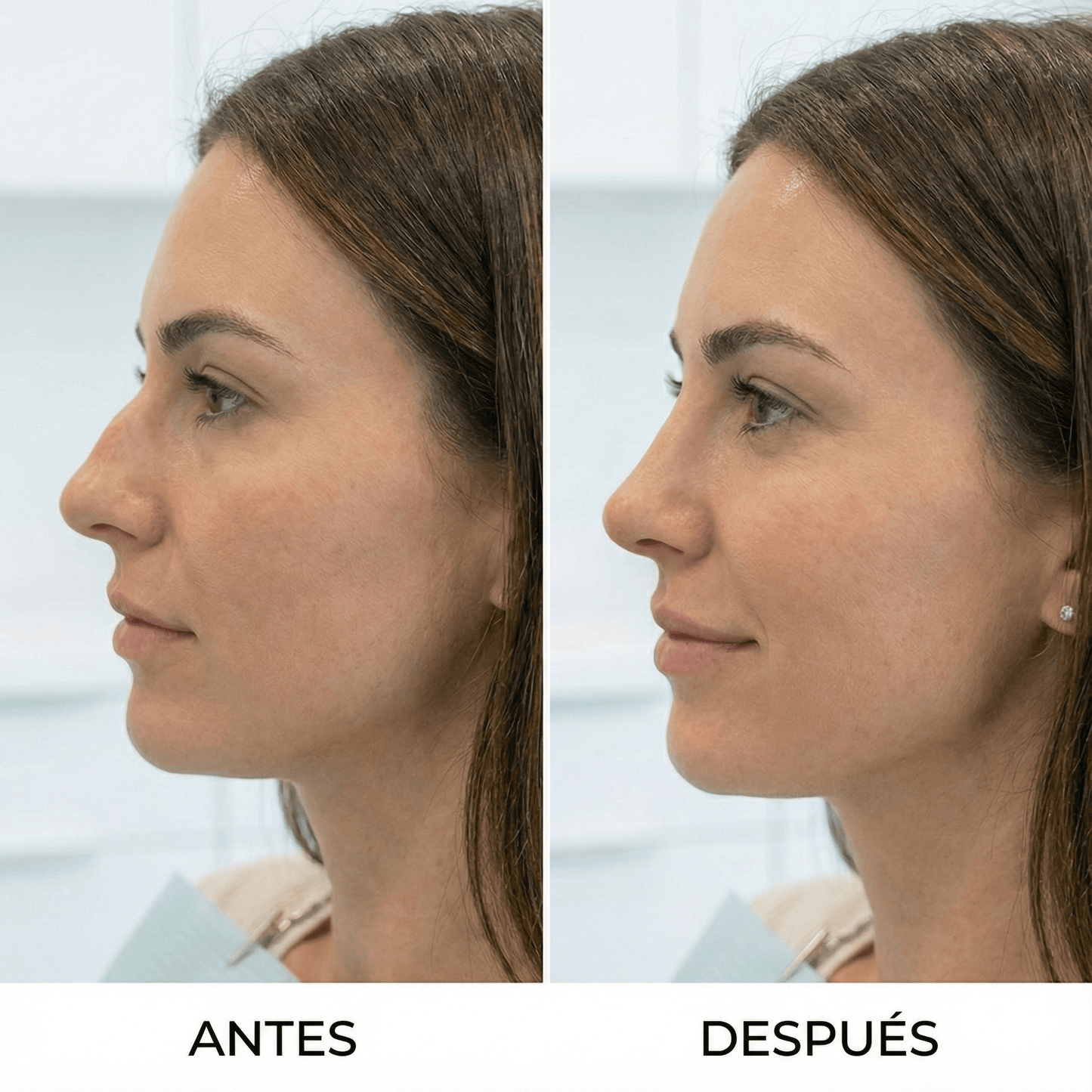 Rinomodelacion con Acido hialuronico